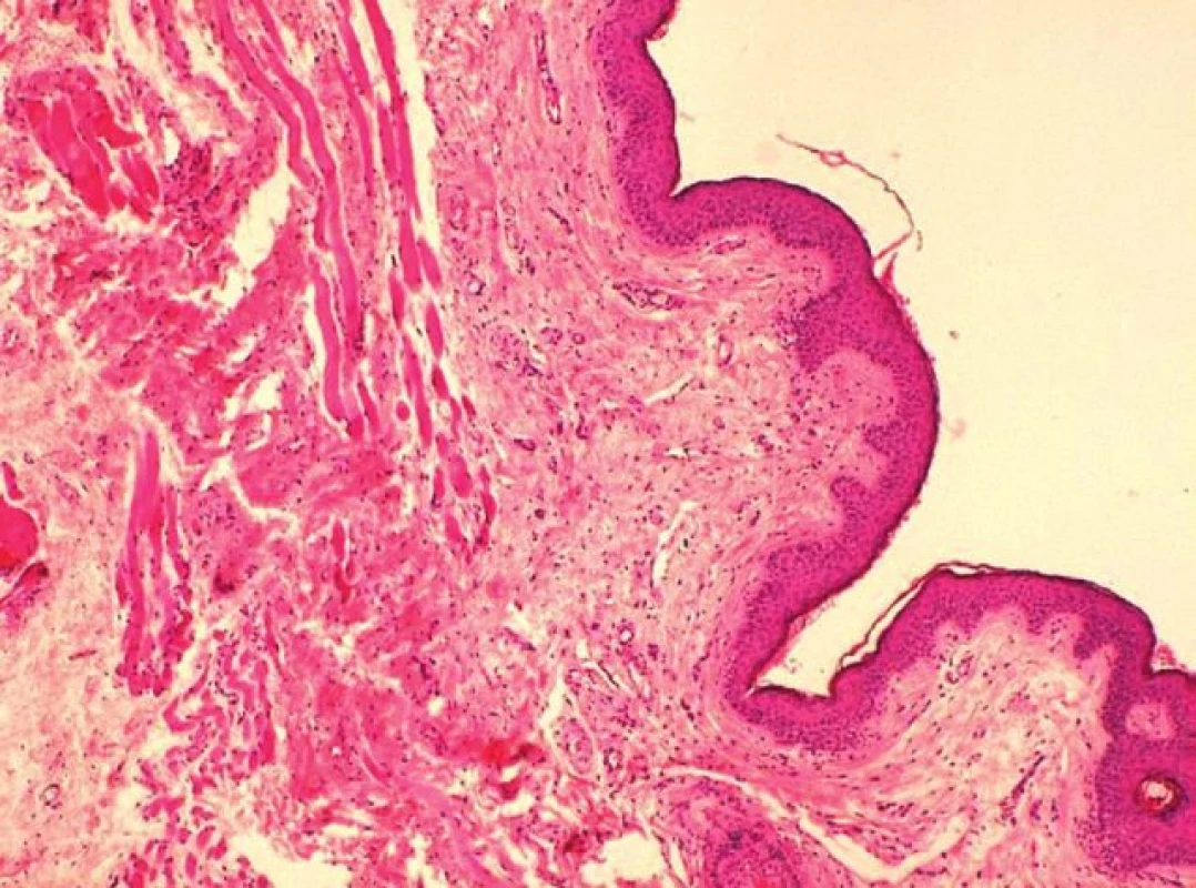 Projizvení a atrofie svalu ve víčku a novotvořené vazivo s drobnými cévami nespecifické granulační tkáně (barvení HE, zvětšení 100x)