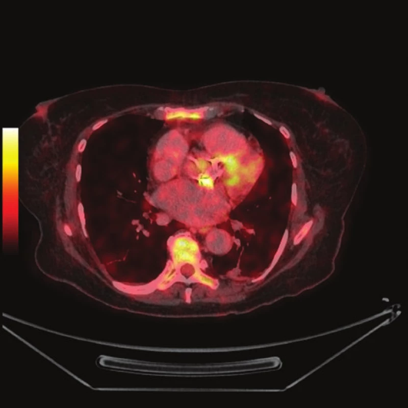 FDG PET/CT z 19. 10. 2012
2a - předozadní MIP, v okolí sleziny patrné drobné hyperaktivity - fraktury žeber (šipky)
2b - PET s korekcí na atenuaci, axiální řez srdcem v úrovni aortálního anulu (ve stejné rovině jako 1b), jsou patrné dva okrsky výrazněji zvýšené akumulace FDG v oblasti aortálního anulu (šipky)
2c - PET bez korekce na atenuaci, axiální řez ve stejné rovině jako 2b
2d - fúze PET/CT, axiální řez v rovině odpovídající 2b