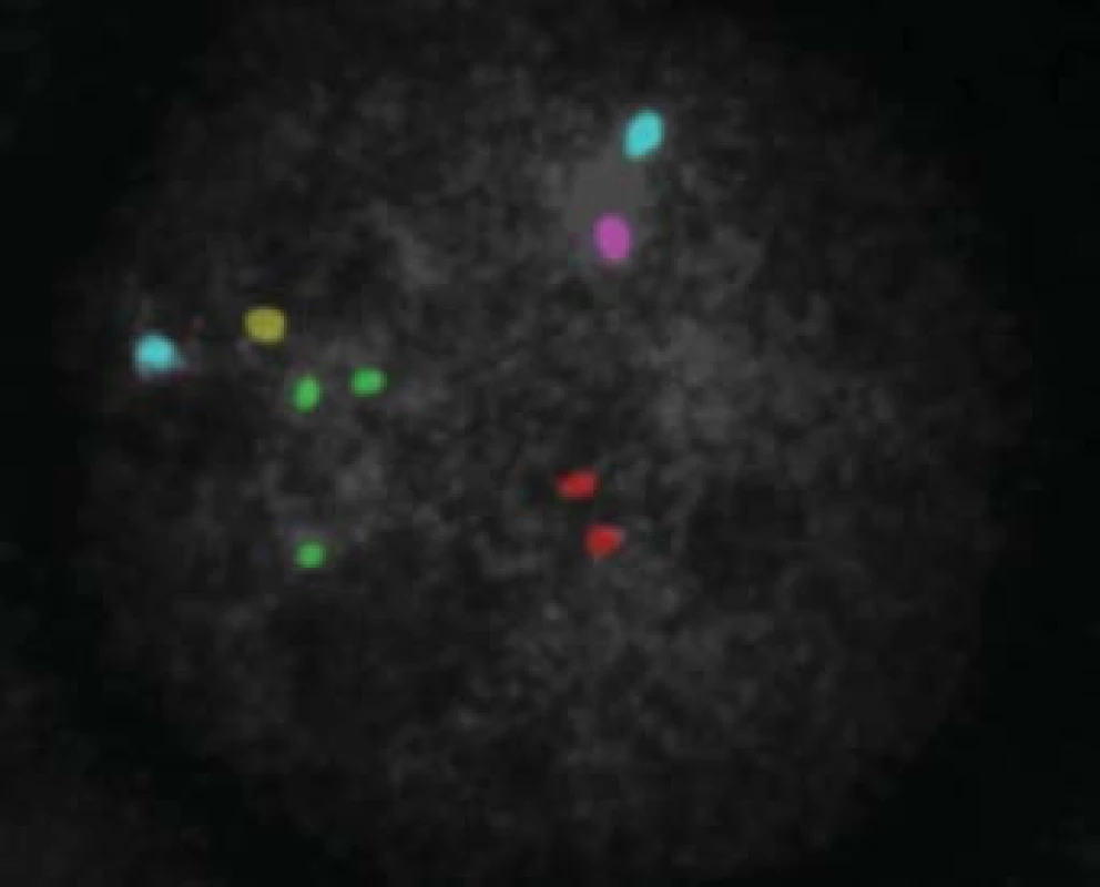 Výsledek po PGD analýze - trisomie 21 chromozomu (zelené signály).