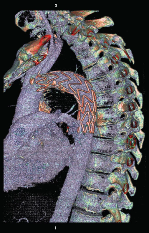 CTA obraz po prvotnej implantácii aortálneho stentgraftu.