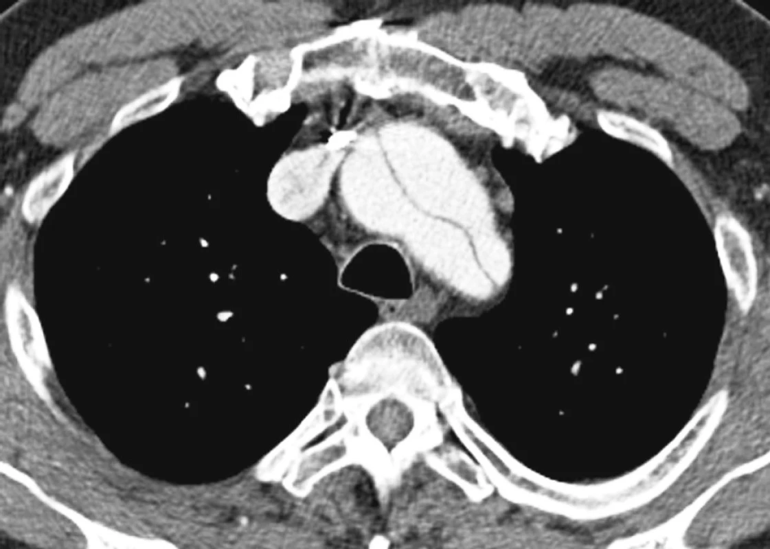 CTAobraz disekce hrudní aorty po náhradě ascendentní aorty
Pic 12. A CTA view of the thoracic aorta dissection following implantation of the ascendent aorta