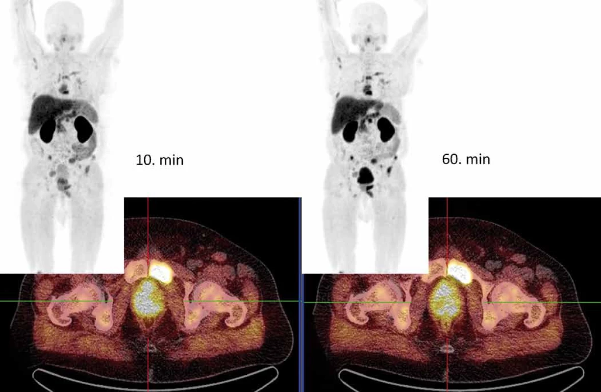 [&lt;sup&gt;18&lt;/sup&gt;F]fluorocholin-PET/low-dose CT.
Vyšetření v 10. min od aplikace radiofarmaka lépe prokazuje zvýšenou akumulaci fluorocholinu v primárním karcinomu prostaty (lokalizační kříž), naopak mnohočetné kostní metastázy jsou lépe patrny při vyšetření v 60. min.