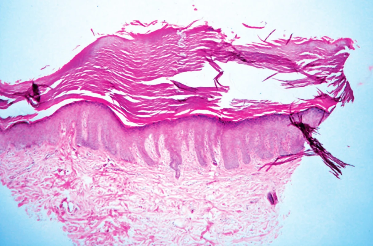 Vkleslina kožního povrchu palmoplantárního typu 
Kůže je vyplněna hyperkeratotickým čepem. 
Zánětlivé infiltráty nejsou přítomny.