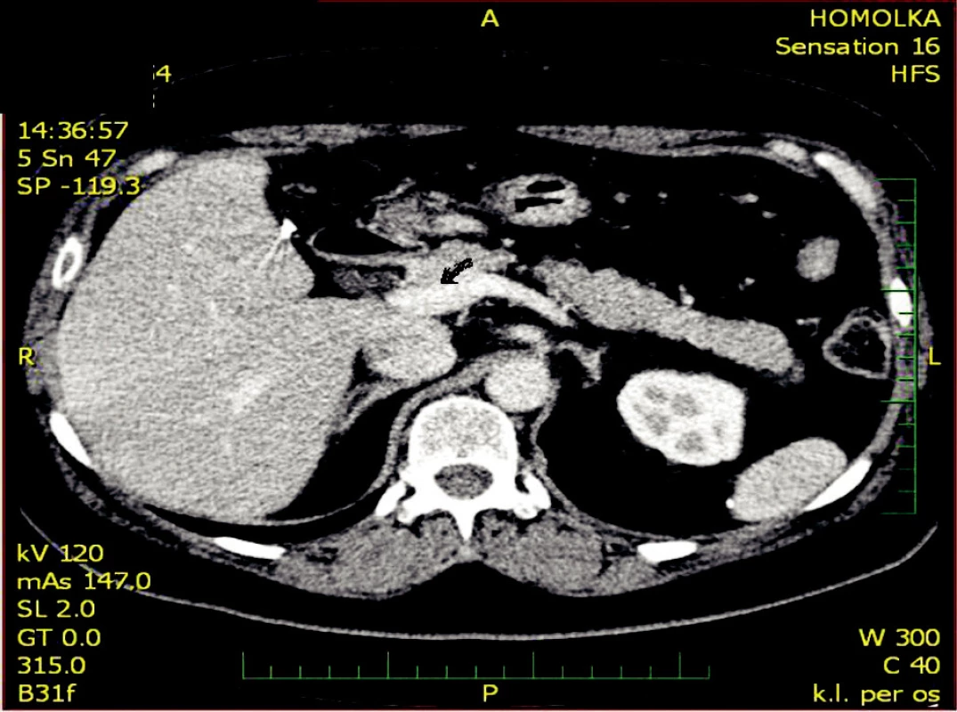 Kontrolní CT po 3 měsících se zachyceným přechodem v. mesenterica superior v portální vénu bez patrného trombu