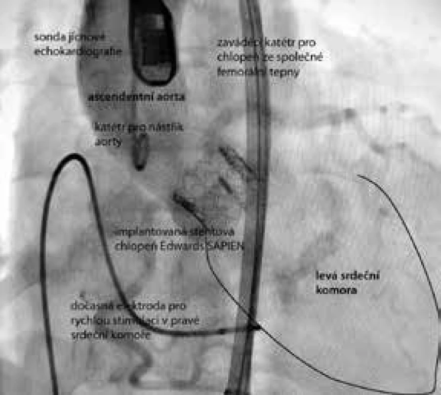 Optimální výsledek po implantaci stentové bioprotézy do nativní aortální chlopně