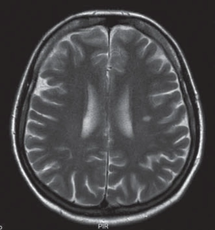 MR mozku – hypersignální ložisko velikosti 10 mm v bílé hmotě supratentoriálně na úrovní centrum semiovale vlevo v T2 obraze.