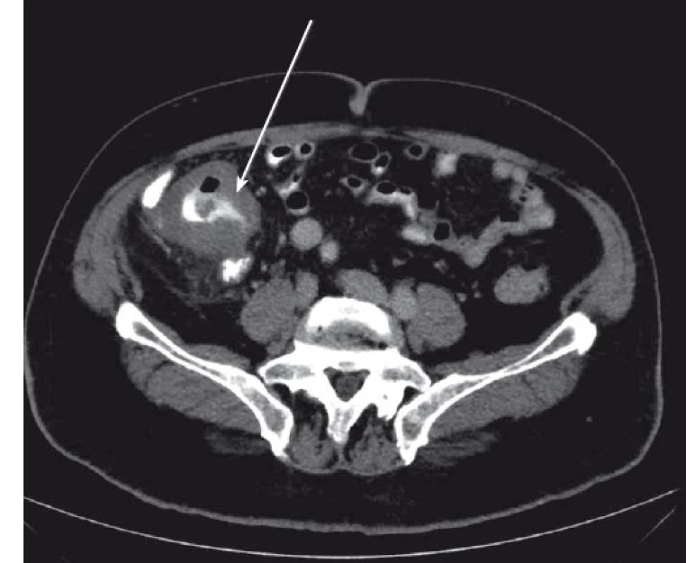 Zesílení stěny céka zánětlivým infiltrátem (šipka).
Fig. 1. Inflammatory swelling of the cecal wall (arrow).