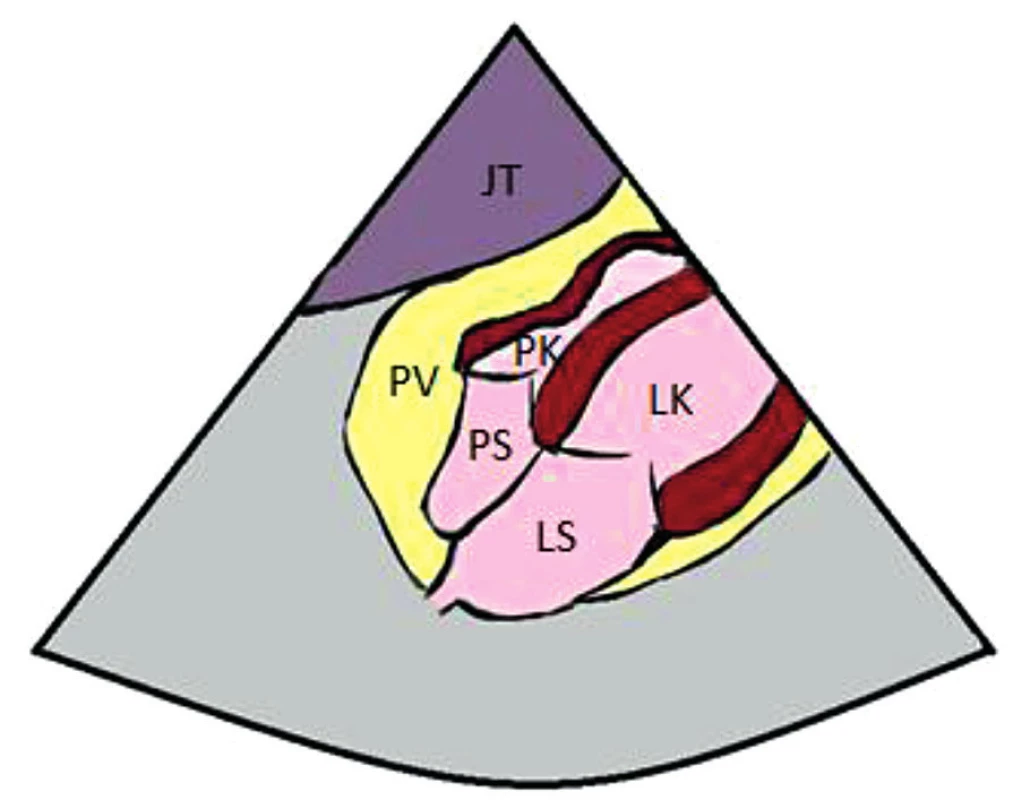 Subxifoidální projekce, kolaps pravé síně a pravé komory
JT – jaterní parenchym, PV – perikardiální výpotek, PK – pravá komora, PS – pravá síň, LK – levá komora, LS – levá síň