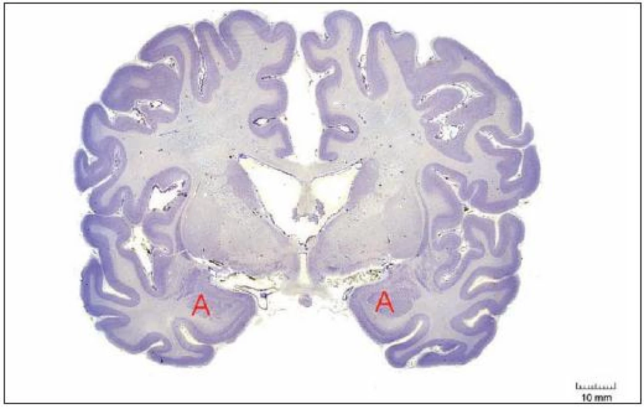 Poloha amygdal v řezu čelní rovinou mozku na úrovni chiasma opticum