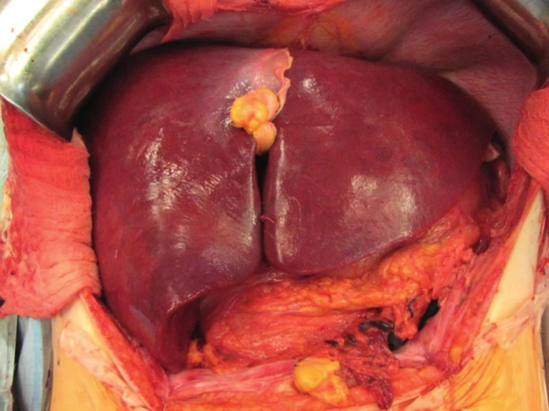 Transplantace jater - pohled na transplantát (štěp) po provedení všech cévních anastomóz.