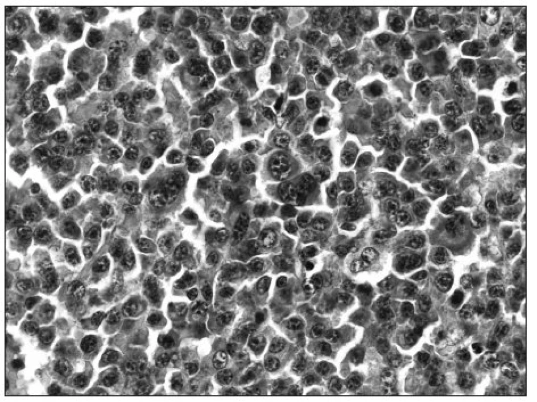 Cytologický detail nádorových buněk, HE 600krát