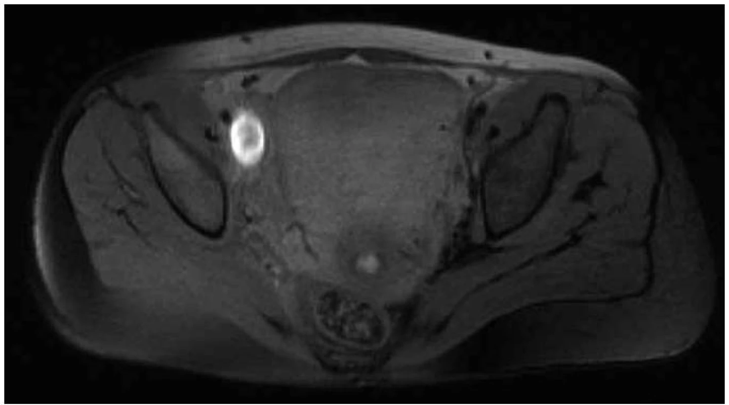 MR zobrazení trombózy hlubokého žilního systému levé dolní končetiny.