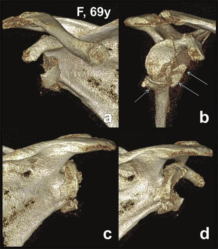 Glenoid fossa fractures (four fragments) with separation in the anatomical neck − CT 3D reconstructions (Pt − 1)