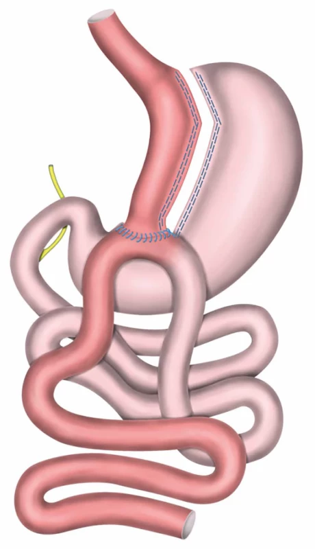Bypass žaludku s jednou anastomózou / minigastrický (OAGB/MGB)    Fig. 2: One anastomosis gastric bypass / mini gastric bypass (OAGB/MGB)