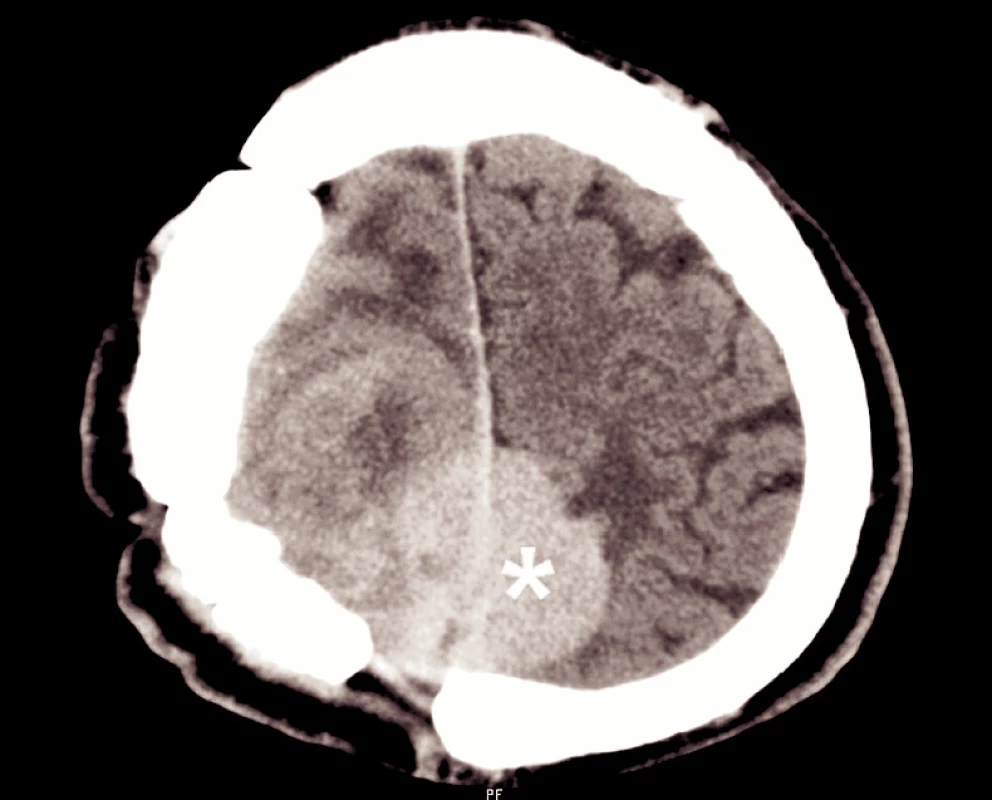 Predoperačný CT nález. Recidivujúci tumor označený hviezdičkou.