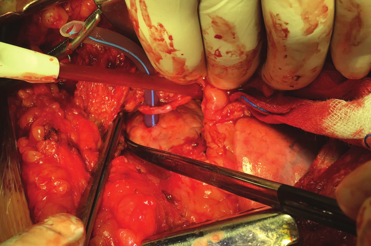 Drén po otevření perikardu prochází stěnou srdeční komory
Fig. 4: Drain passes through the wall of the ventricle after opening the pericardium