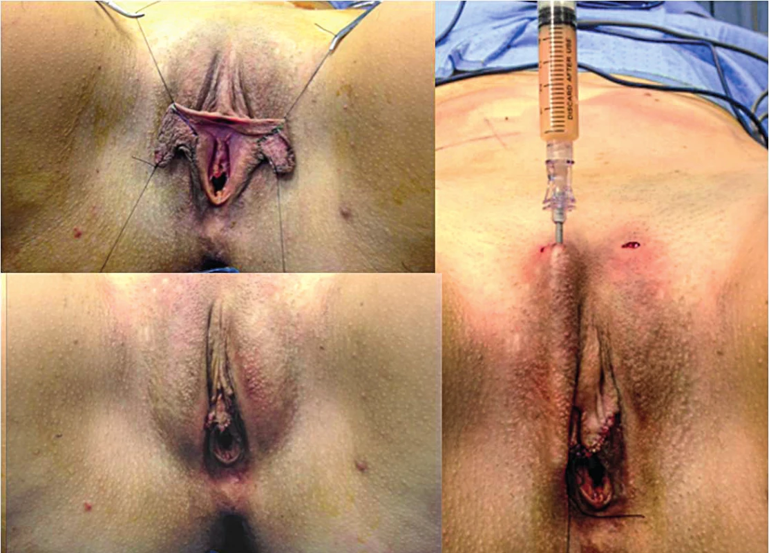 (Above left) Pre-operative marking for labia hypertrophy correction. (Below) Lipofilling of labia majora. (Above right) Postoperative view at 6 months