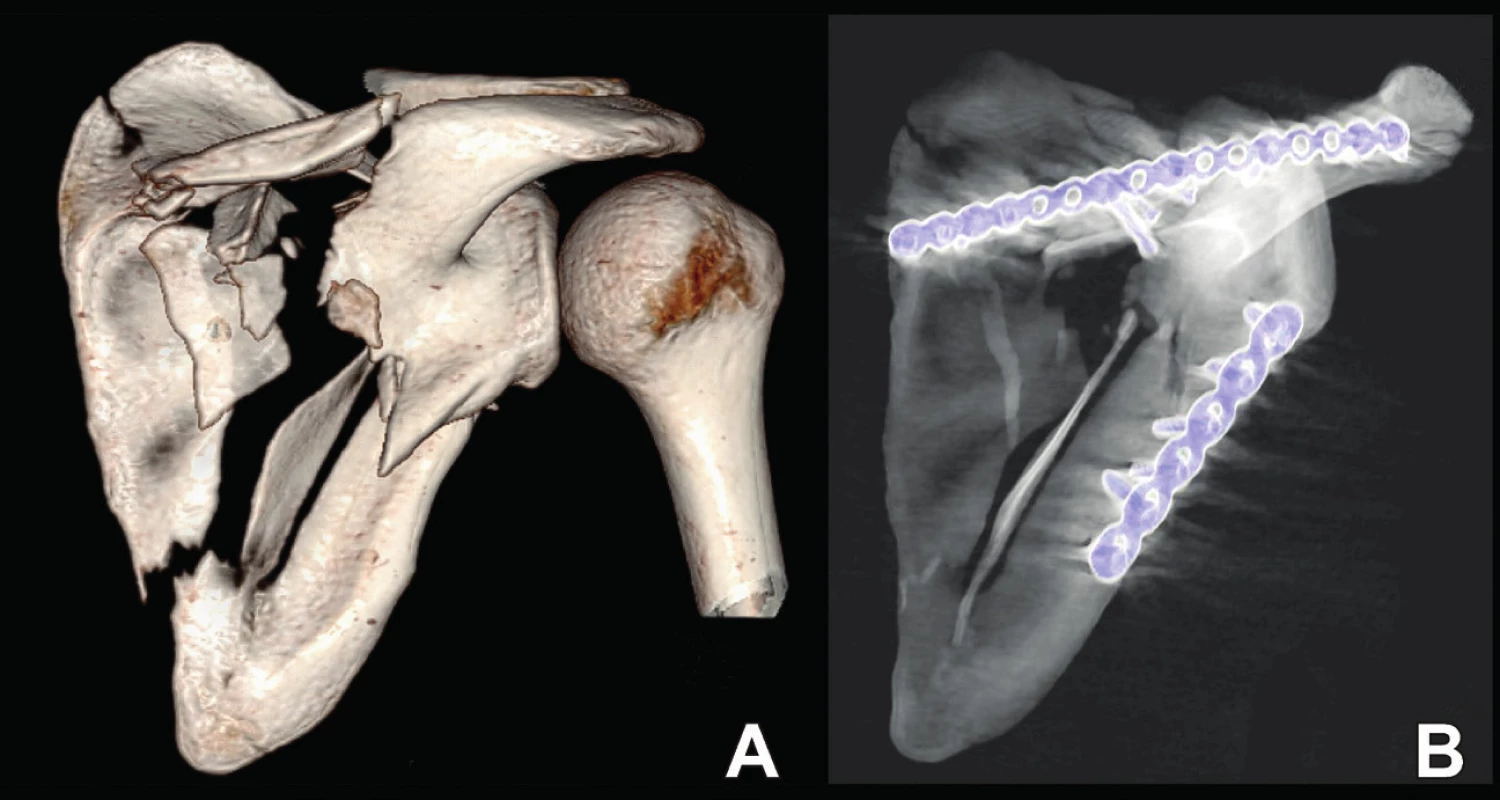 Osteosyntéza zlomeniny anatomického těla: A – situace po úrazu; B – situace po operaci.
Fig. 11: Internal fixation of anatomic body: A – post-injury radiograph; B – postoperative radiograph.