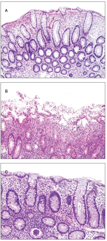 Findings in the colonic mucosa. A - edema, hemorrhage and increased proliferation of the crypt epithelium, B - erosion of the superficial epithelium, C - basal cryptitis.