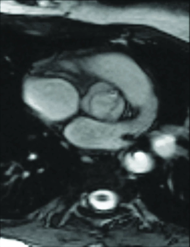 MRI aortální chlopně – bikuspidální aortální chlopeň u pacientky s TS (archiv autorů).