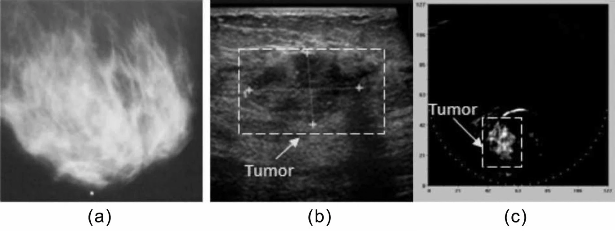 Příklad klinického využití fotoakustické tomografie.
(a) mediolaterální mamografie, (b) ultrasonogram,
(c) optoakustický obraz. Vysoký kontrast objektu v obraze
(c) svědčí pro zhoubný nádor. Přetištěno se svolením [15].