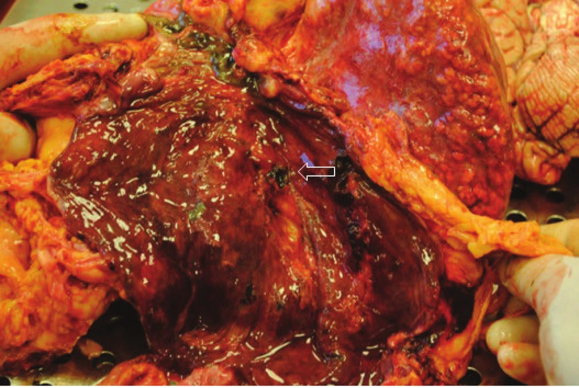 Sekční nález − sliznice žaludku se známkami portální hypertenzní gastropatie
Fig. 5: Autopsy fading − entricular mucosal signs of portal hypertensive gastropathy