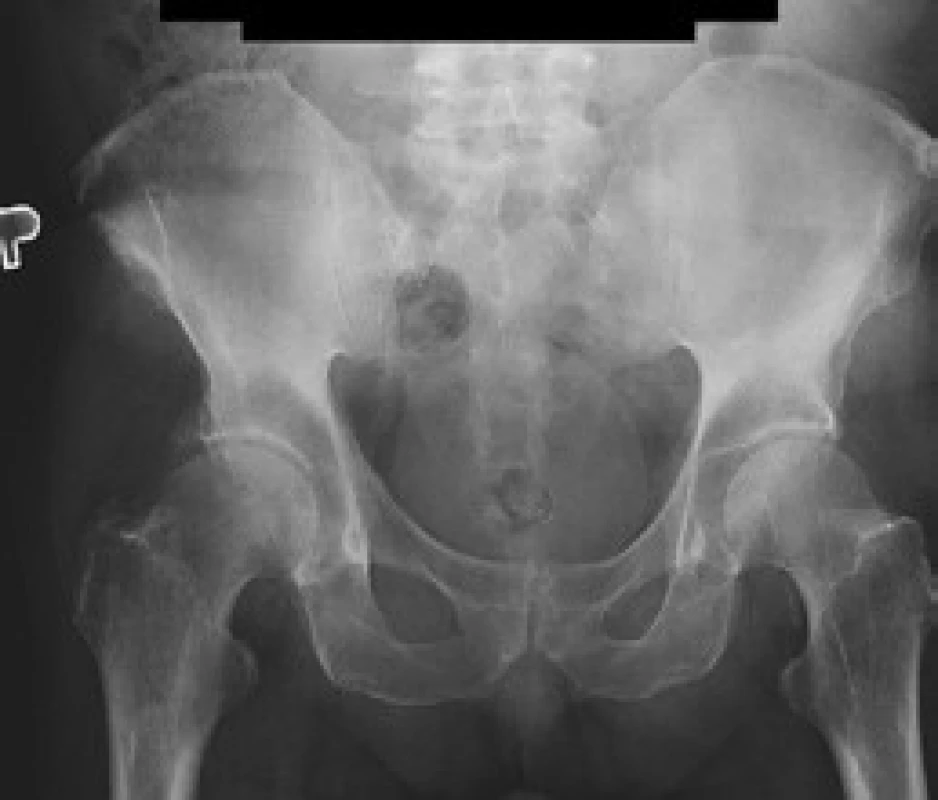 Mírné ztluštění kostní struktury na bazi lopat kyčelních kostí, více vlevo (srovnat s CT snímkem).