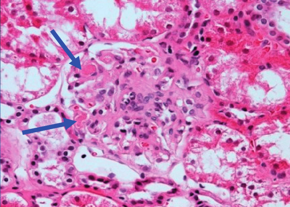 Histologický preparát renálního glomerulu v barvení hematoxilin-eosin. Modré šipky ukazují na místa trombotické mikroangiopatie.