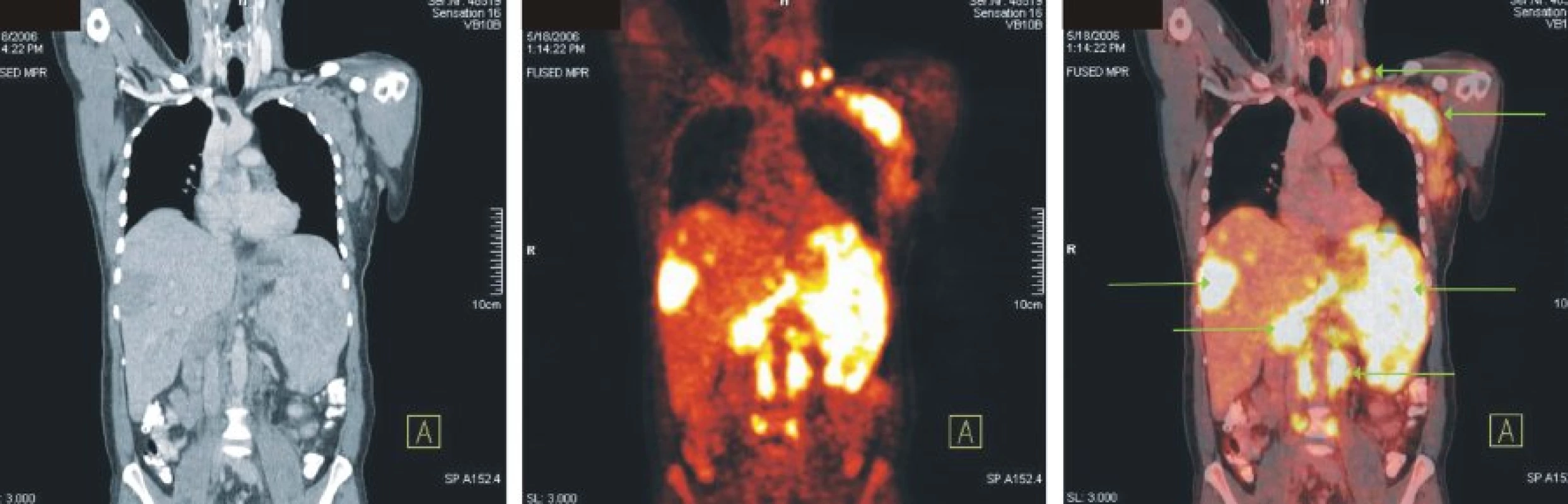 Snímky výpočetní tomografie (CT), pozitronové emisní tomografie (PET) a PET/CT u nemocného s difuzním B-velkobuněčným lymfomem. Zvýšená akumulace FDG v lymfatických uzlinách v levém nadklíčku, v paketu uzlin levé axily, paraaortálně a v mnohočetných ložiscích ve výrazně zvětšené slezině a játrech.