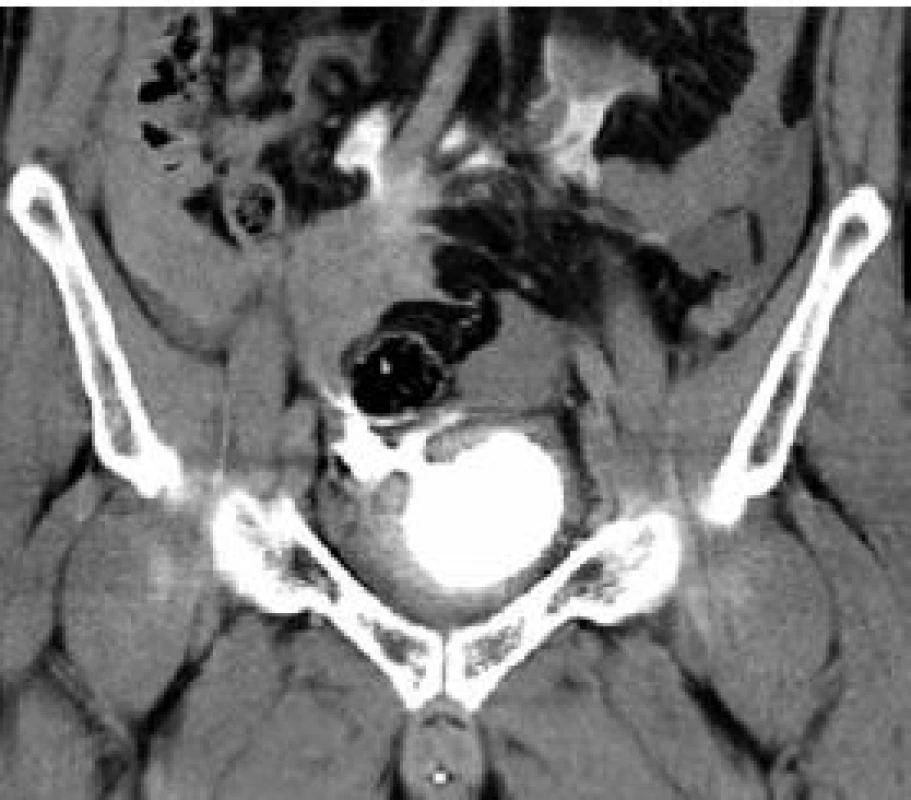 CT pánve (koronární řez) – intraperitoneální ruptura močového měchýře (pravý přední kvadrant)
Fig. 5. CT of pelvis (coronal section) – intraperitoneal rupture of the urinary bladder (front right quadrant)