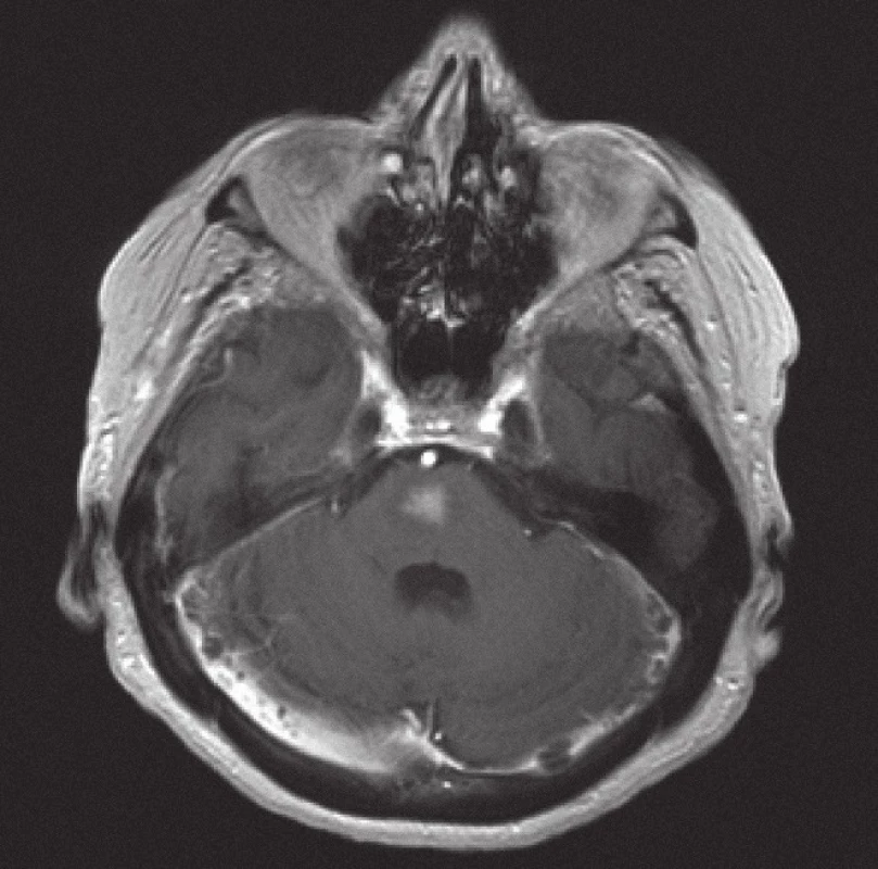 Magnetická rezonance, SE MTC T1 s kontrastní látkou. Pacientka C. R. 1934, kontrastně se sytící infiltrát lymfomu v mozkovém kmeni zřetelně zmenšený po 10 dnech kortikoterapie ve srovnání se vstupním stavem na obr. 5.