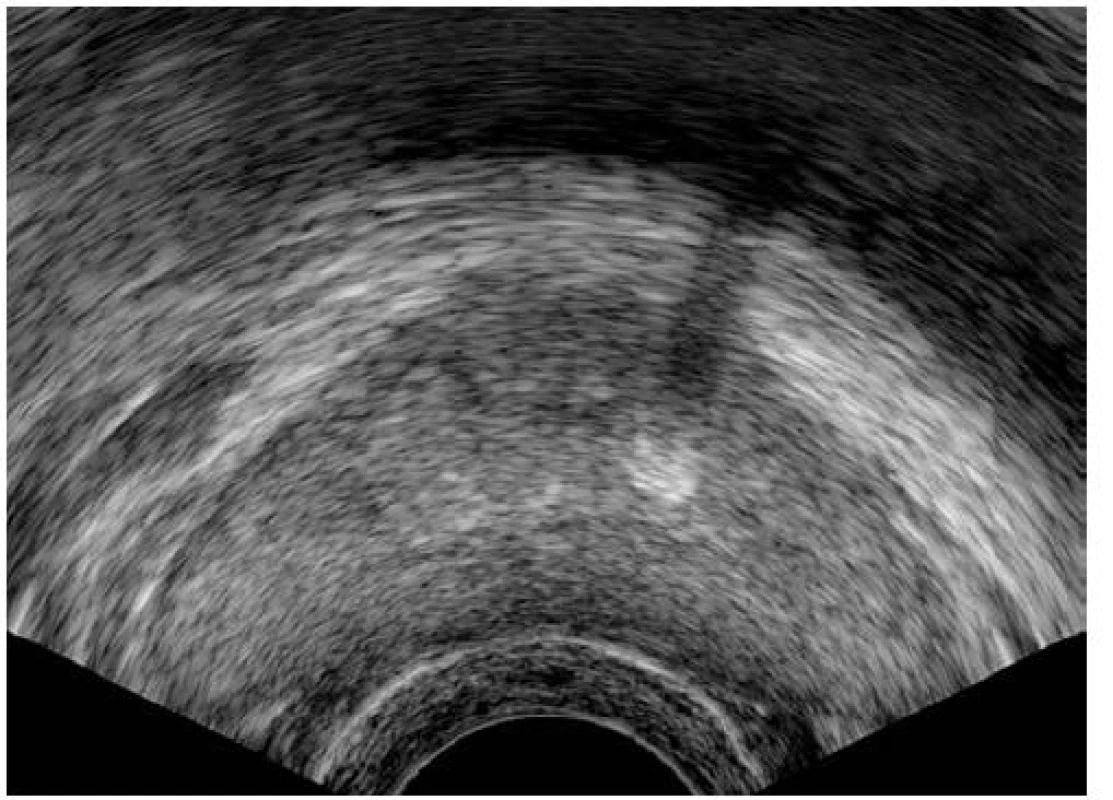 Prostatolitiáza o velikosti 5 × 3 mm v levém laloku prostaty u 31letého muže (5. rok substituční léčby), příčná rovina