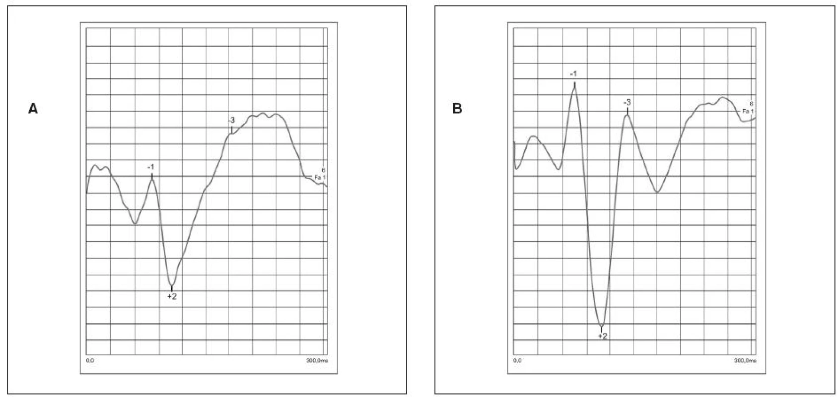 Záznam VEP krivky zaznamenaný z amblyopického oka pred liečbou (a) záznam VEP krivky z vedúcich a zdravých očí (b) – NPN komplex označený číslami 1, 2, 3. Pri amblyopii vidno predĺženie latencií a zníženie amplitúd NPN komplexu
