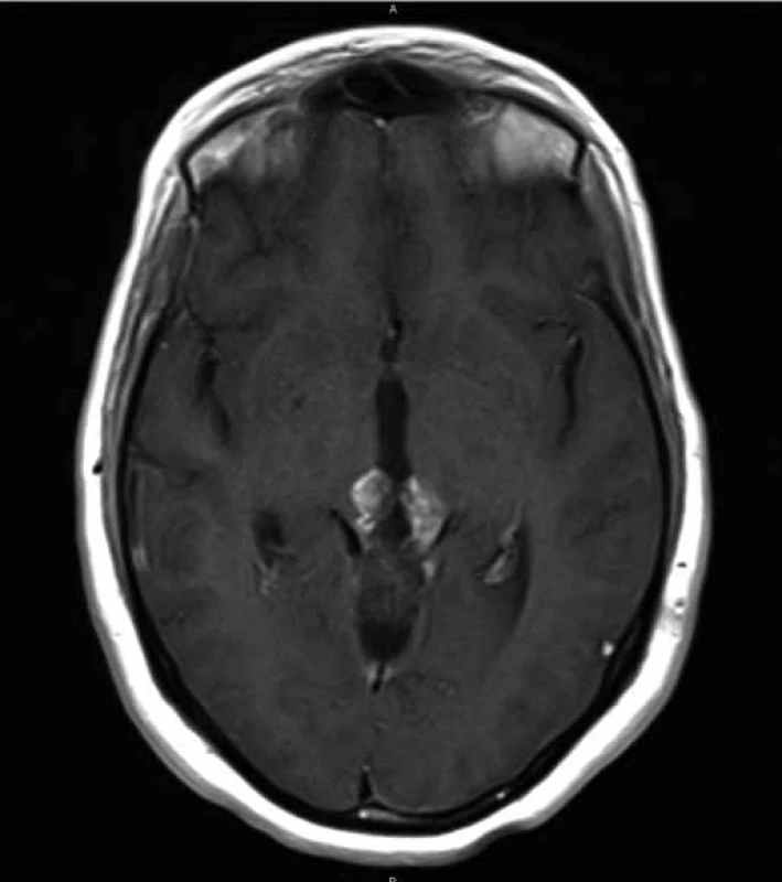 Postoperative transversal T1 MRI constrast enhanced section of the gross residual tumor (max. diameter of 2.6 cm).