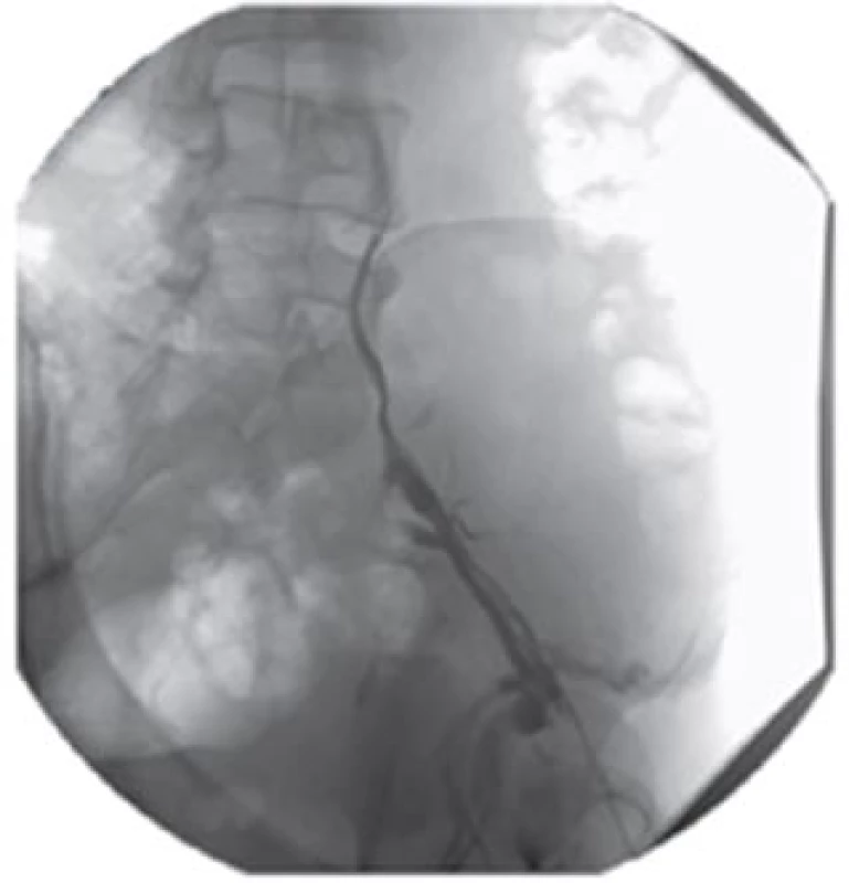Stenóza pánevního řečiště
Fig. 3: Stenosis of pelvic vasculature