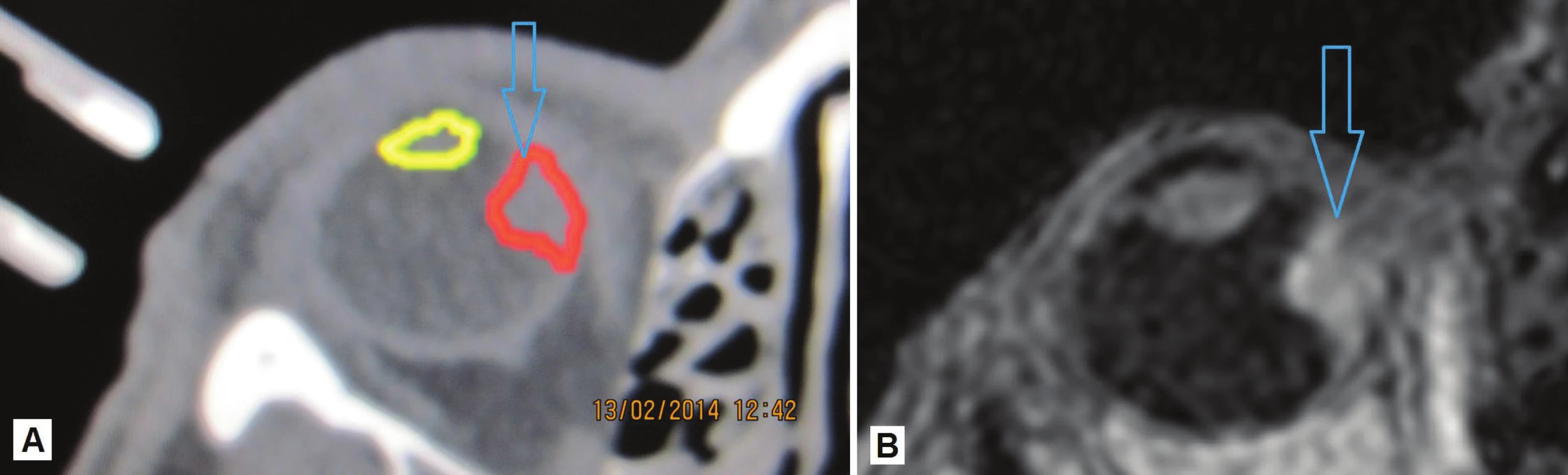 Zakreslenie nádorového ložiska vychádzajúceho z oblasti corpus ciliare s prerastaním smerom „dozadu“ do oblasti choroidy – ložisko červená farba, šošovka žltá farba (A), MR zobrazenie oka s ložiskom (B)