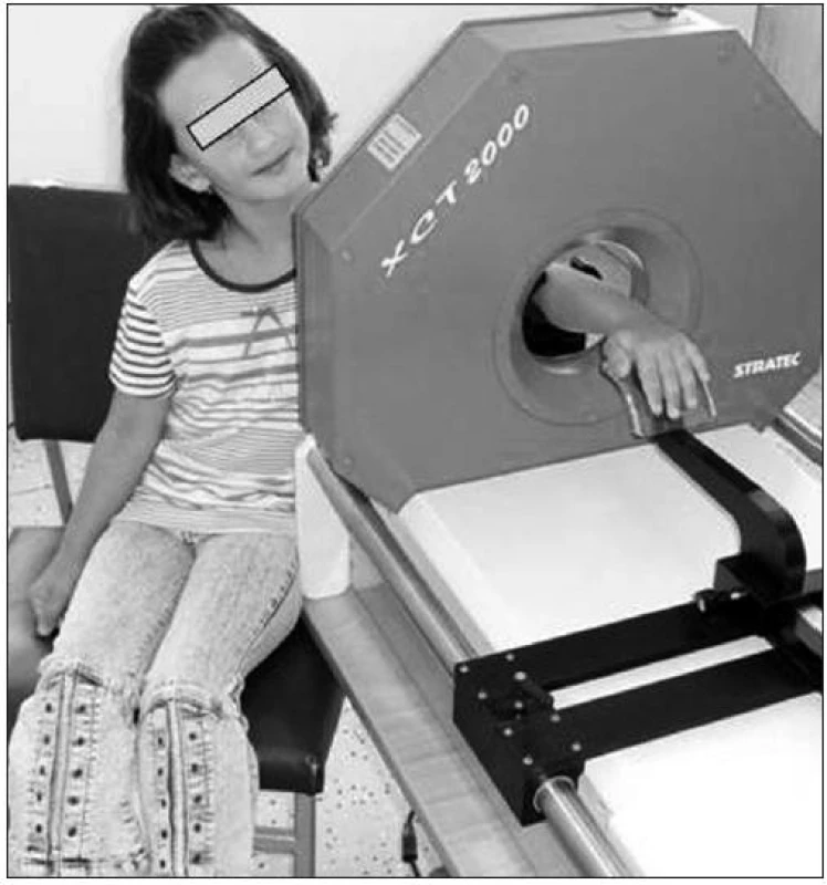 Volumometrické měření kvality kosti pomocí periferní kvantitativní počítačové tomografie (pQCT). Tato metoda dovoluje přímo zhodnotit skutečný obsah kostního minerálu v daném objemu kostní tkáně. Naopak výsledky měření plošné (areální) kostní denzity, např. metodou dvoufotonové rentgenové absorpciometrie (DXA), je u dětí před vyjádřením výsledku nutné přepočítat podle věku, pohlaví, ale zejména podle výšky postavy (z archivu Ondřeje Součka).