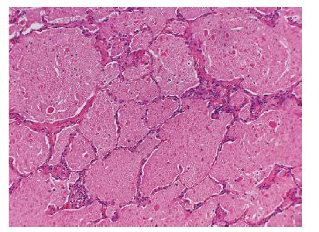 PAP. V obraze dominuje rozšíření a vyplnění alveolů jemně granulovanou bezbuněčnou eozinofilní hmotou