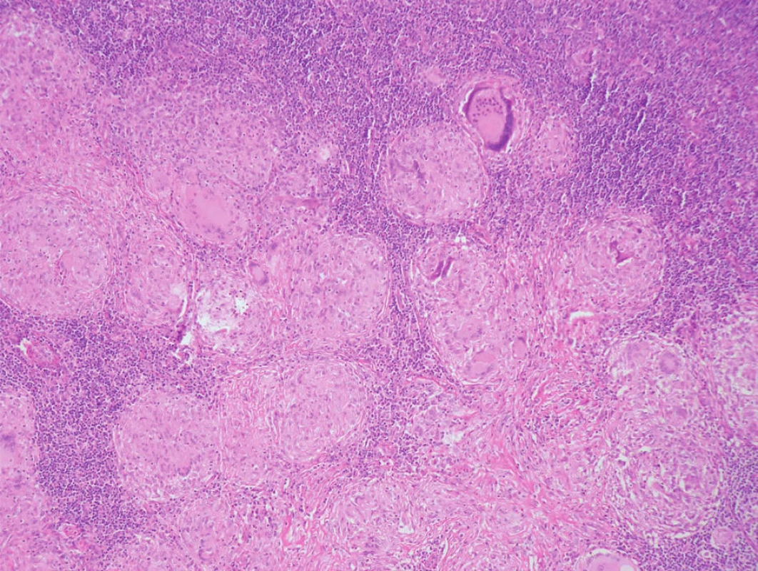 Sarkoidóza v lymfatické uzlině, vícečetné nekaseifikující granulomy, nápadné obrovské mnohojaderné buňky Langhansova typu s věncem jader.