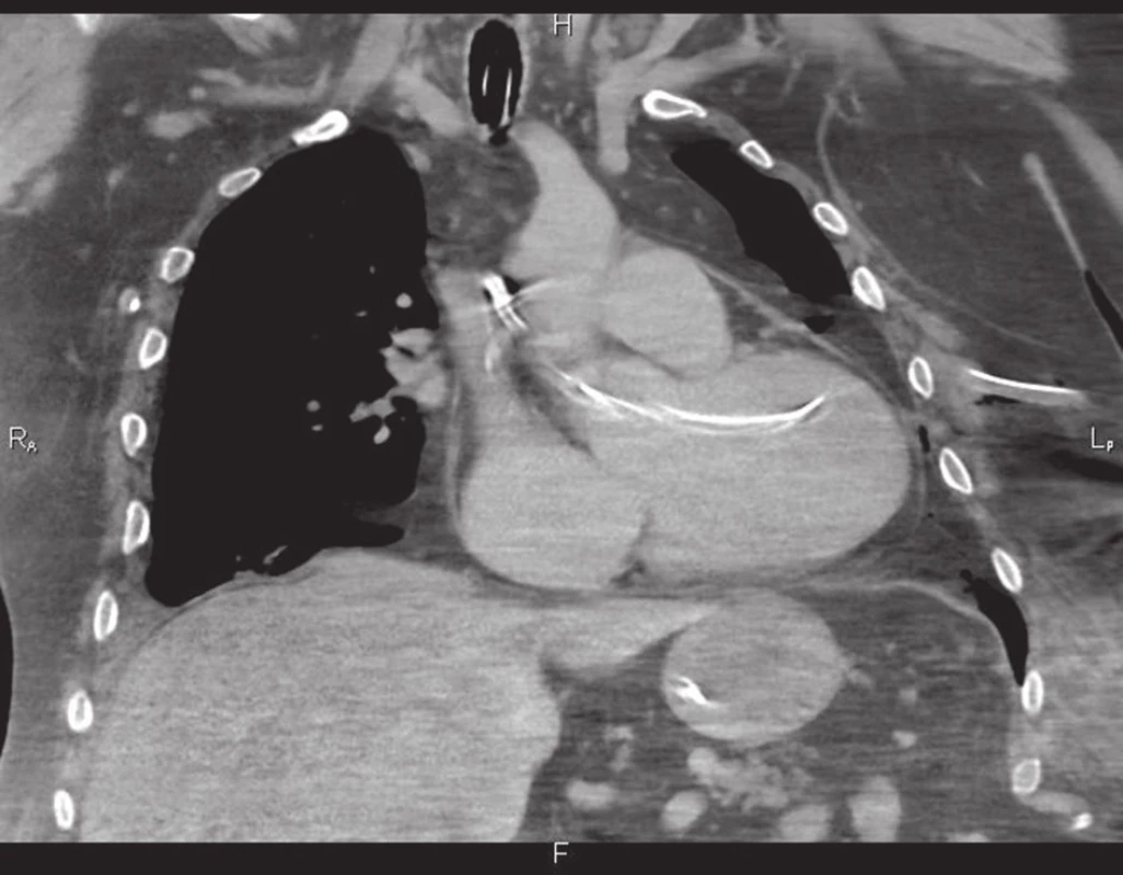 Drén procházející hrudní stěnou do levé komory a až do vzestupné aorty
Fig. 3: Drain passing through the chest wall into the left ventricle and up to the ascending aorta
