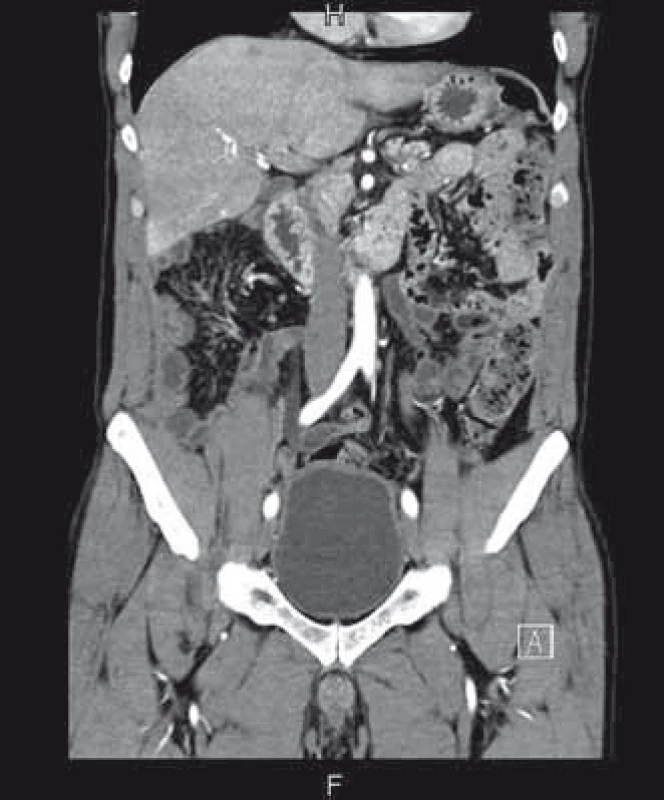 CT břicha 6 měsíců po léčbě, kde je patrná prakticky kompletní regrese.
Fig. 3. Abdominal CT 6 months after treatment with almost complete regression.