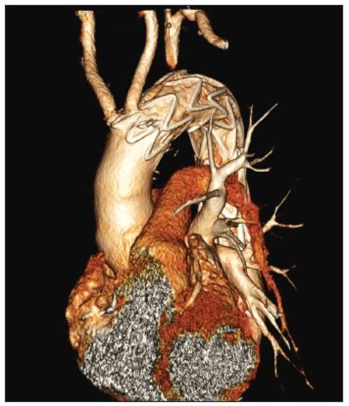54-ročný muž s aneuryzmatickou dilatáciou anomálne odstupujúcej arteria subelavia dextra (arteria lusoria).
Stav po implantácii hrudného stentgraftu do oblasti aortálneho oblúka a dodilatovaní stentgraftu CT angiografia aortálneho oblúka.
Fig. 6. A 54-year old male with aneurysmal dilatation of an abnormal arteria subclavia dextra (arteria lusoria). Following thoracic stentgraft implantation into the aortic arch region and completion of the stentgraft dilation. CT angiography of the aortic arch. 