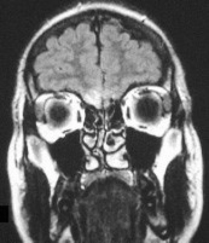Kazuistika 3: MR mozku, koronární řezy, T2 vážená sekvence u pacientky s poúrazově vzniklou anosmií. Hypersignální ložiska na orbitální ploše frontálních laloků, výraznější vpravo.