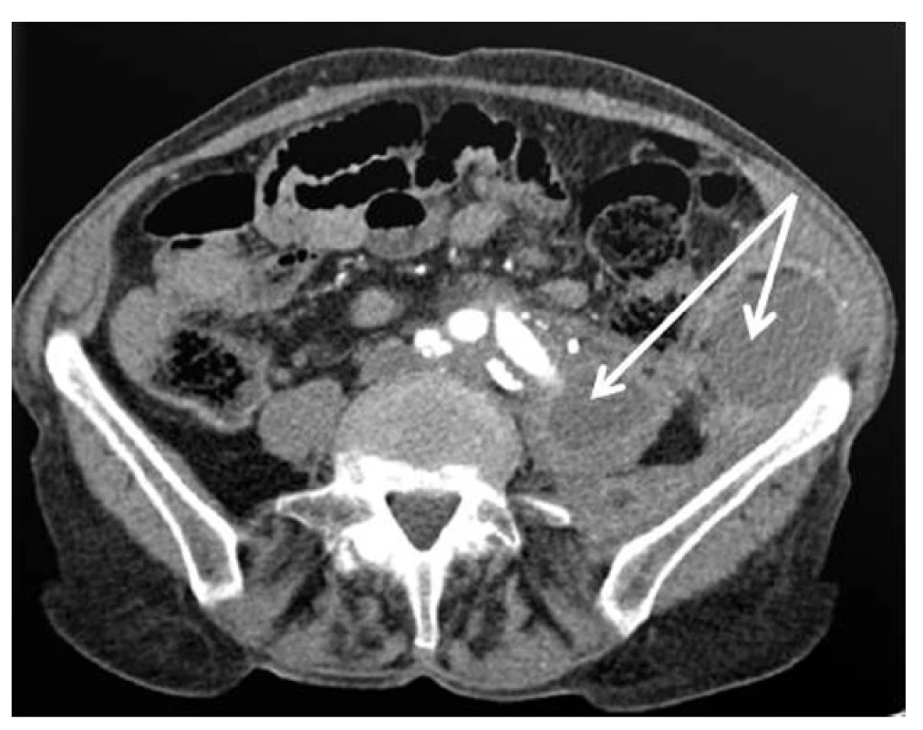 Snímek infekce aortobifemorální protézy (šipky ukazují tekutiny kolem levého raménka protézy)
Fig. 1: Aortobifemoral graft infection (peri-graft fluid collection marked by arrows)