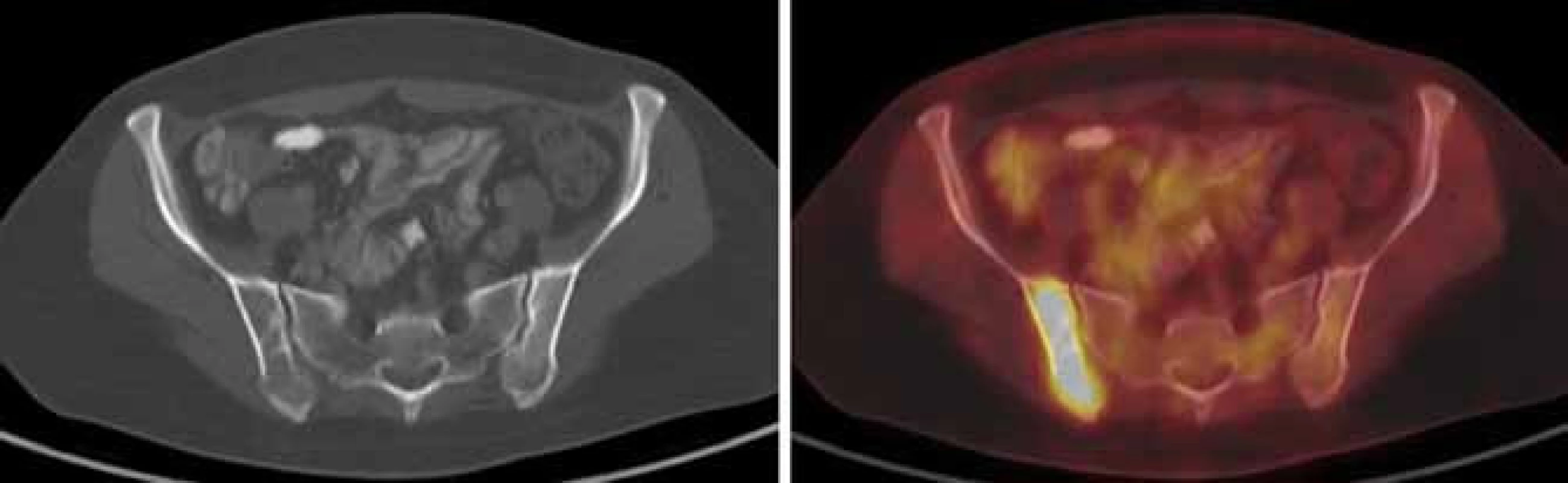 V CT obrazu jen naznačeno nevýrazné prořídnutí pravé lopaty kyčelní, ložisko ve skeletu vykazuje jednoznačně patologickou akumulaci FDG – osteolytická metastáza při diseminaci karcinomu levého prsu.