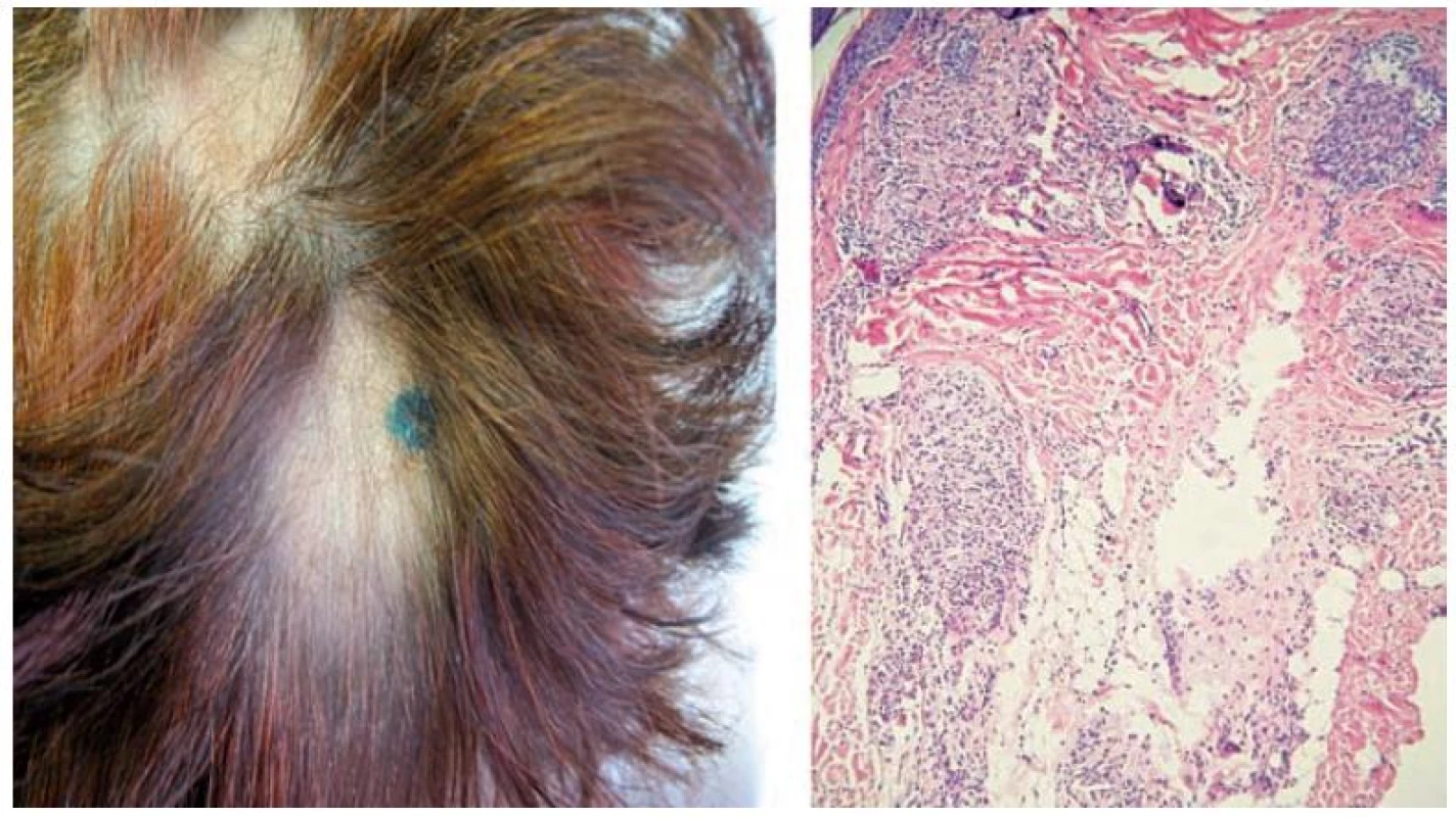 Ložiska alopecie histologicky s průkazem granulomů sarkoidálního typu (he, 200x)