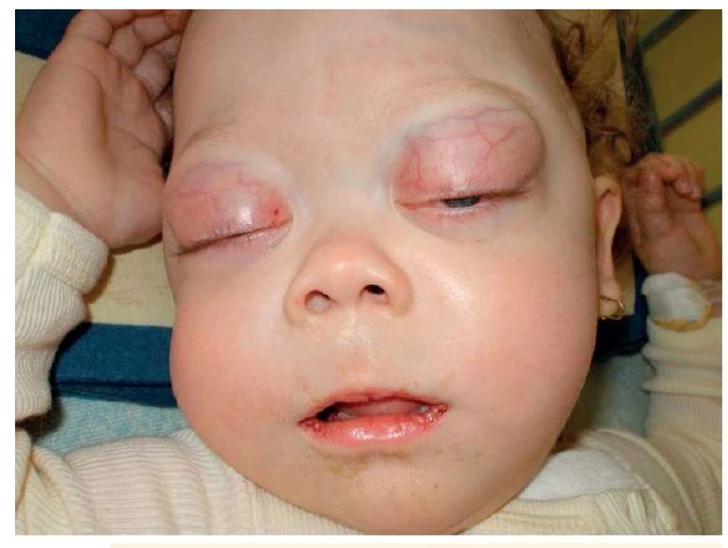 Extramedulární postižení při AML: infiltrace orbit u dítěte s akutní monocytární leukémií.
