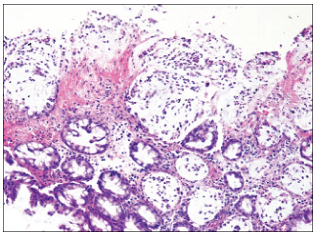 Biopsie tračníku u plně vyvinuté pseudomembranózní kolitidy. 