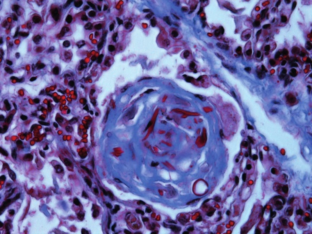 Pľúcne „hassalloidné“ teliesko s fibrotizáciou a zvyškami bunkového komponentu (Massonov modrý trichróm, 240x).
