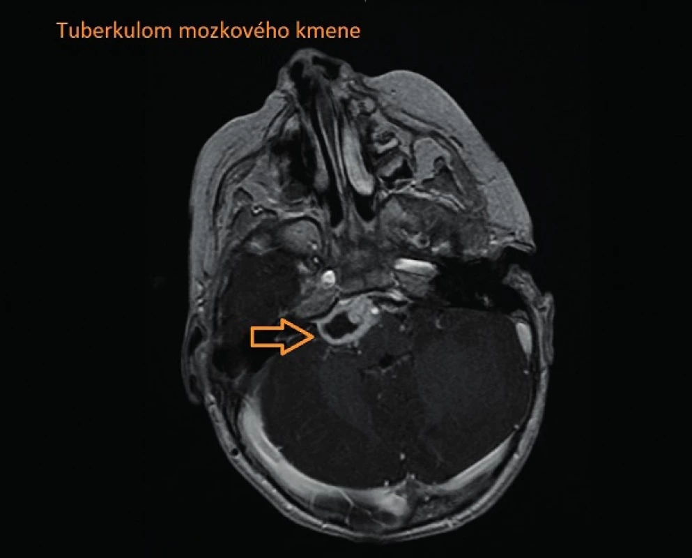 Tuberkulom mozkového kmene.
Fig. 3. Brain-stem tuberculoma.